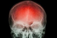 A cada 40 segundos, alguém sofre um AVC. Saber como reagir pode fazer a diferença.