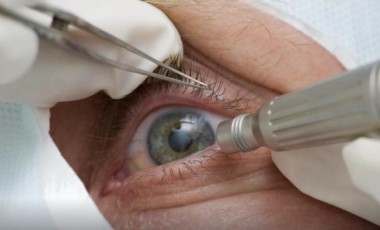 Lula faz cirurgia de catarata; entenda a doença e o procedimento