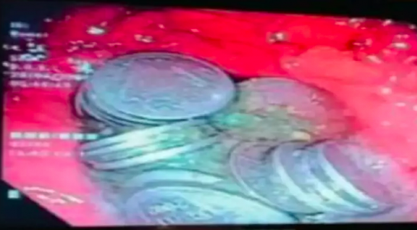 Dor de estômago escondia 63 moedas no estômago de paciente