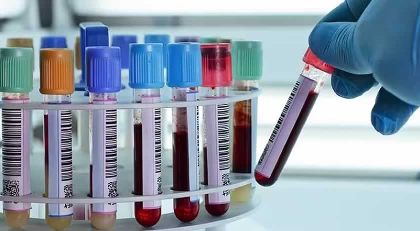 Exame de sangue pode detectar 90% dos casos de Alzheimer, diz estudo