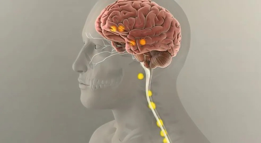 Sintomas de Alzheimer em jovem de 19 anos desafia estudos sobre doença
