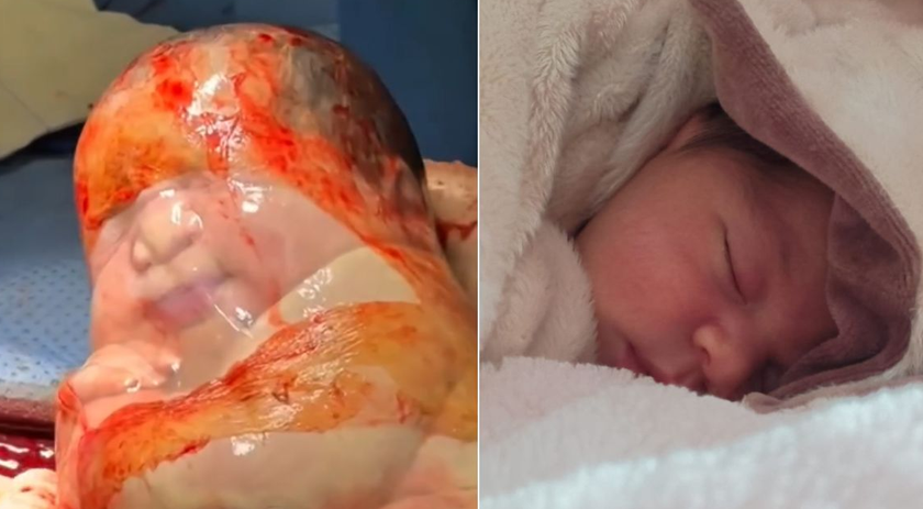 Mãe vence gestação difícil e revela bastidores de parto raro em SC