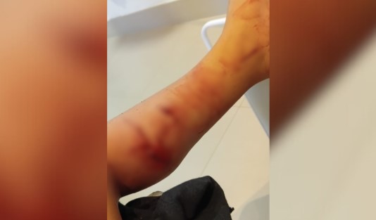 Criança de 3 anos é atacada por cachorro próximo a creche em Ponte Serrada