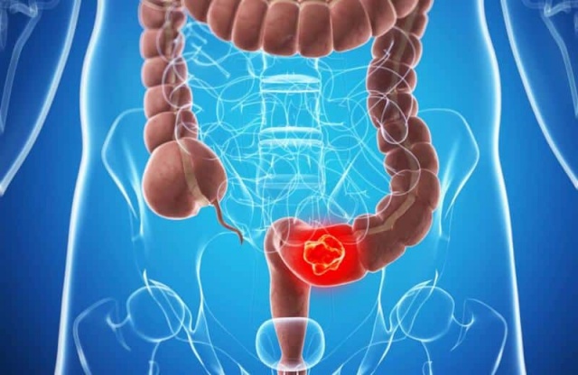 Oncologista explica aumento da incidência do câncer de intestino na população mais jovem
