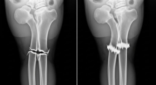 Superbonder para ossos: nova cola promete substituir gessos e cirurgias para curar fraturas