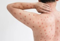 Mpox em Santa Catarina: número de casos suspeitos chega a 16