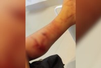 Criança de 3 anos é atacada por cachorro próximo a creche em Ponte Serrada