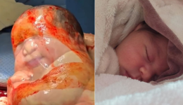 Mãe vence gestação difícil e revela bastidores de parto raro em SC