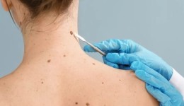 SC é o estado que mais registra casos de melanoma no Brasil