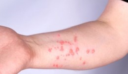 Sem casos confirmados, SC reforça alerta e prevenção contra Mpox