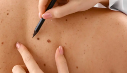 SC tem um dos maiores riscos de câncer de pele do Brasil, aponta Inca