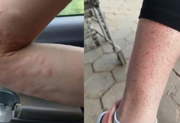 Moradores usam casaco e luvas em calor de 30°C para se proteger de infestação de mosquito em SC: 'Avançam no rosto da gente'