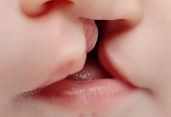 SUS passa a oferecer cirurgia de lábio leporino e tratamento completo pelo sistema público