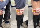 Estudantes de medicina no Paraguai são presos no Paraná com 800 ampolas de emagrecedores coladas ao corpo