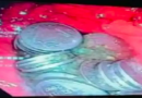 Dor de estômago escondia 63 moedas no estômago de paciente