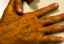 Pacientes do SUS terão acesso a tecnologia inovadora para tratamento de câncer de pele