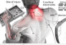 Dispositivo faz paraplégicos recuperarem os movimentos das mãos e dos braços