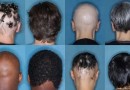 Anvisa aprova novo medicamento para tratar queda de cabelo