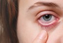 Sem sintomas iniciais, doença caracterizada por aumento da pressão nos olhos pode levar à cegueira