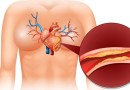 Infarto e derrame: conheça os riscos do colesterol alto para a saúde