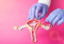 Laqueaduras em SC: cinco meses após a alteração da lei, esterilização feminina aumenta em 51%