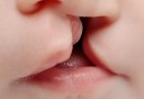 SUS passa a oferecer cirurgia de lábio leporino e tratamento completo pelo sistema público