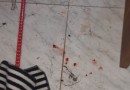Em briga de casal, mulher joga álcool em si mesma e tem 50% do corpo queimado em SC