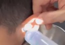 Médico remove do ouvido de uma criança três caroços, um talo de uva e uma barata