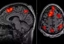 Estudo clínico registra primeiro tratamento bem-sucedido para a doença de Huntington