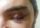 Jovem detalha agressão sofrida em Jaraguá do Sul: ‘vi a raiva nos olhos dele’