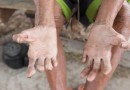 Por que Brasil é o segundo país com mais casos de hanseníase no mundo