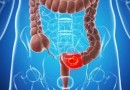 Oncologista explica aumento da incidência do câncer de intestino na população mais jovem