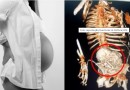 Idosa de 81 anos descobre estar ‘gestando’ feto calcificado há cinco décadas
