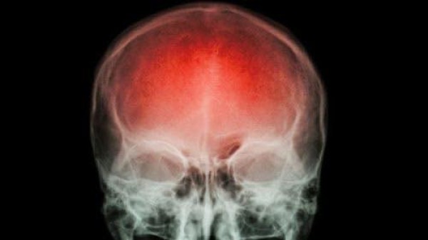 A cada 40 segundos, alguém sofre um AVC. Saber como reagir pode fazer a diferença.