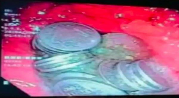 Dor de estômago escondia 63 moedas no estômago de paciente