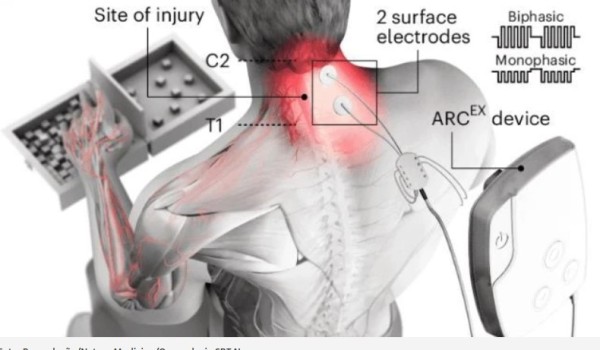 Dispositivo faz paraplégicos recuperarem os movimentos das mãos e dos braços