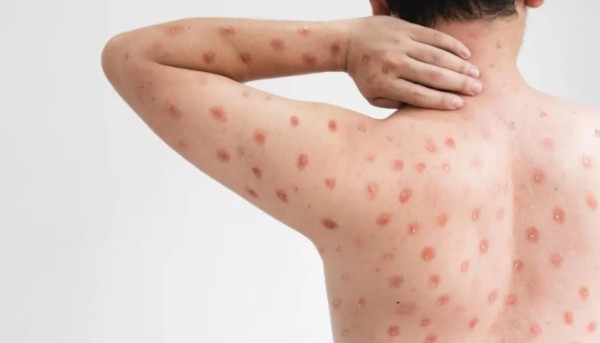 Mpox em Santa Catarina: número de casos suspeitos chega a 16