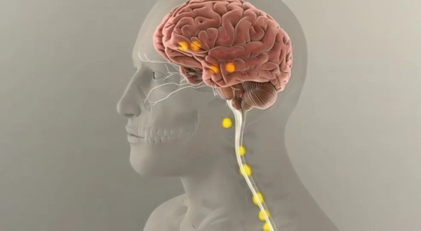 Sintomas de Alzheimer em jovem de 19 anos desafia estudos sobre doença