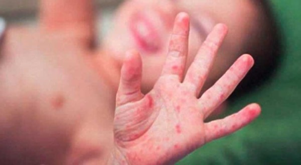 Chapecó enfrenta surto de doença 'mão-pé-boca' em oito escolas