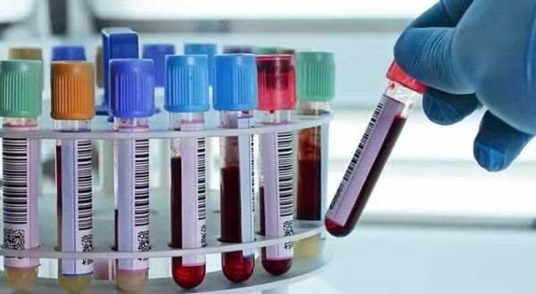 Exame de sangue que rastreia Alzheimer pode virar real, diz estudo
