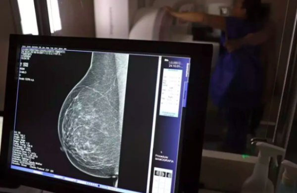 Vacina inédita contra o câncer de mama mostra eficácia de 75% e surpreende cientistas