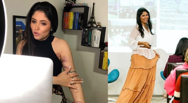 Mulher que sofreu descarga elétrica de 10 mil volts em Chapecó fala sobre superação