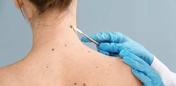 SC é o estado que mais registra casos de melanoma no Brasil
