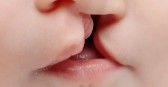 SUS passa a oferecer cirurgia de lábio leporino e tratamento completo pelo sistema público