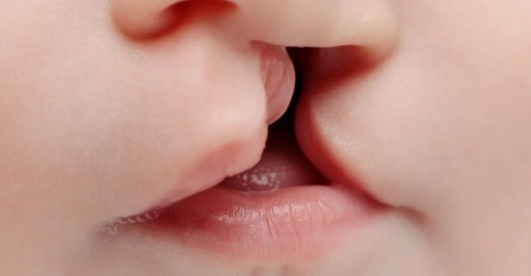 SUS passa a oferecer cirurgia de lábio leporino e tratamento completo pelo sistema público