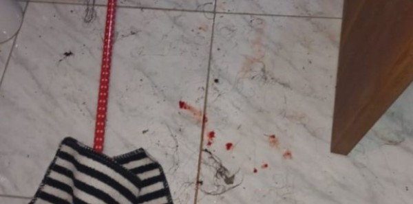Em briga de casal, mulher joga álcool em si mesma e tem 50% do corpo queimado em SC