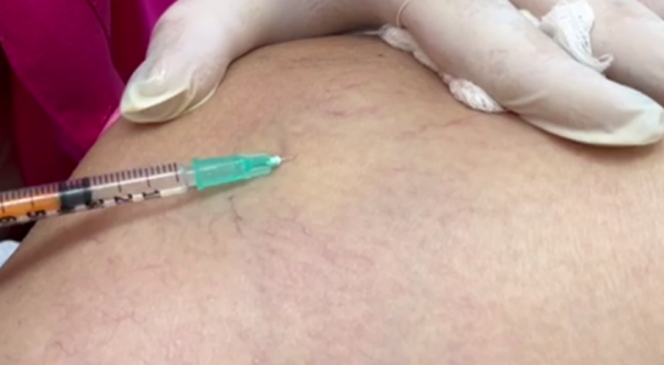 Egidia Costa fala sobre o tratamento de secagem dos famosos “ Vasinhos”