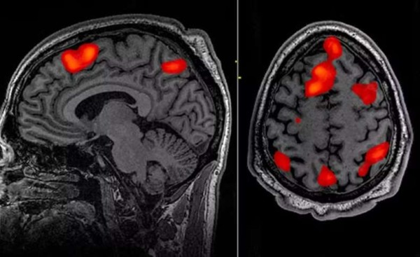 Estudo clínico registra primeiro tratamento bem-sucedido para a doença de Huntington