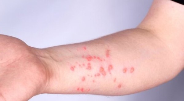 Sem casos confirmados, SC reforça alerta e prevenção contra Mpox