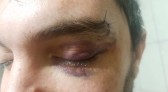 Jovem detalha agressão sofrida em Jaraguá do Sul: ‘vi a raiva nos olhos dele’